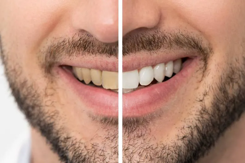 Clareamento dental em Itupeva - SP