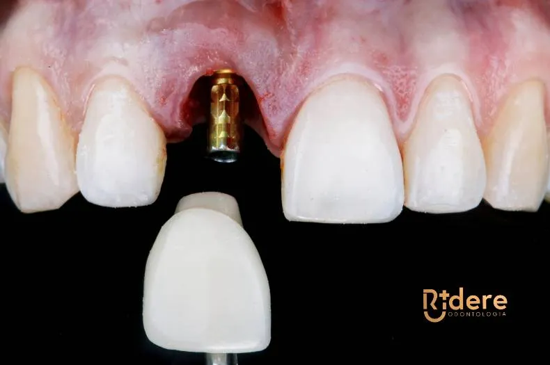 Implante dentário em Itupeva - SP