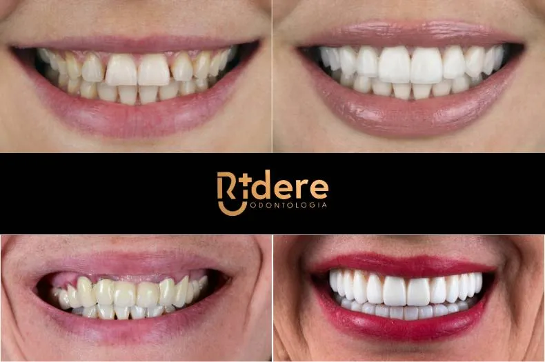 Facetas e lentes de contato dental em Jundiaí - SP